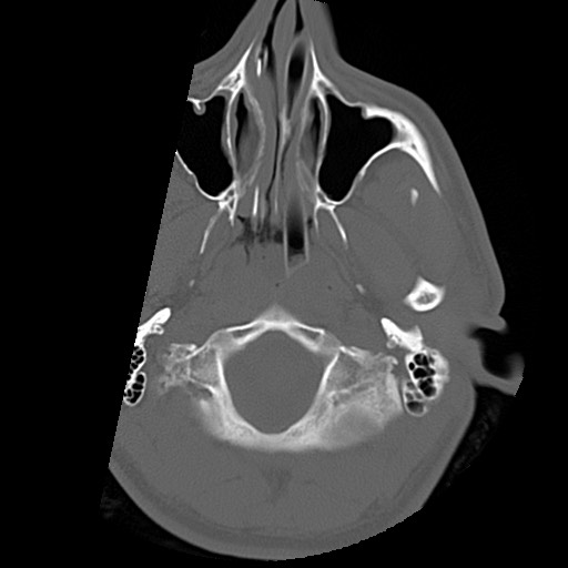 File:Chondrosarcoma - sphenoid wing (Radiopaedia 58259-67828 Axial bone window 1).jpg