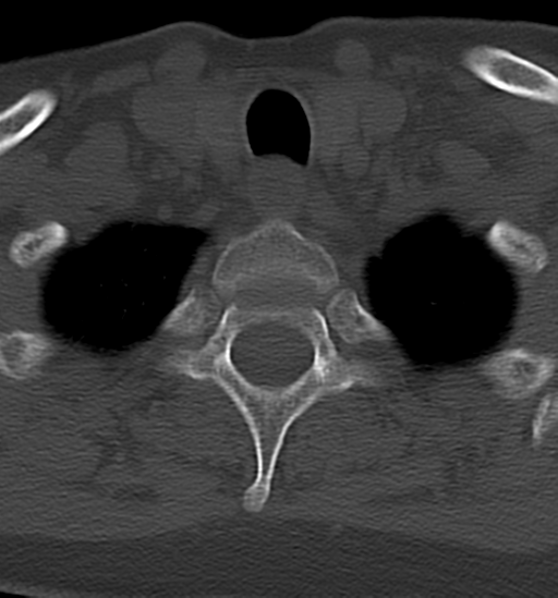 File:Chordoma (C4 vertebra) (Radiopaedia 47561-52188 Axial bone window 45).png