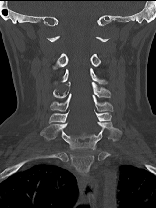 Chordoma (C4 vertebra) (Radiopaedia 47561-52188 Coronal bone window 28).png