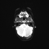 File:Choroid plexus papilloma (Radiopaedia 84612-100019 Axial DWI 5).jpg