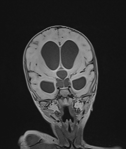 Choroid plexus papilloma (Radiopaedia 84612-100019 Coronal FLAIR 50).jpg