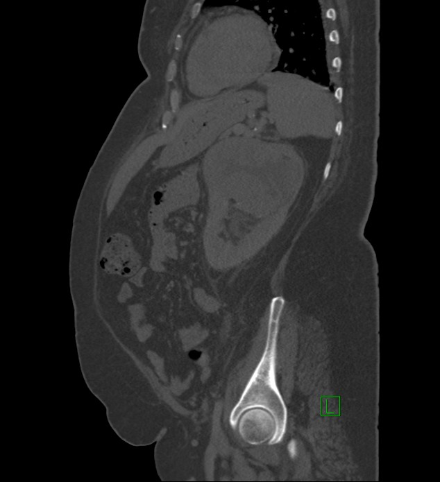Chromophobe renal cell carcinoma (Radiopaedia 84239-99519 Sagittal bone window 30).jpg