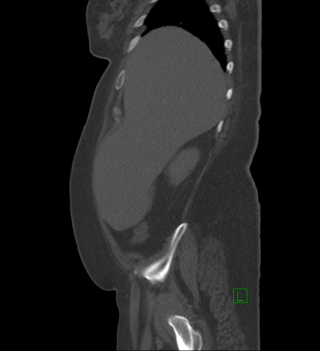 Chromophobe renal cell carcinoma (Radiopaedia 84239-99519 Sagittal bone window 89).jpg