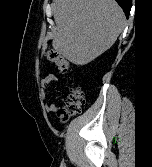 Chromophobe renal cell carcinoma (Radiopaedia 84286-99573 C 152).jpg