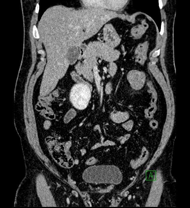 Chromophobe renal cell carcinoma (Radiopaedia 84286-99573 H 66).jpg