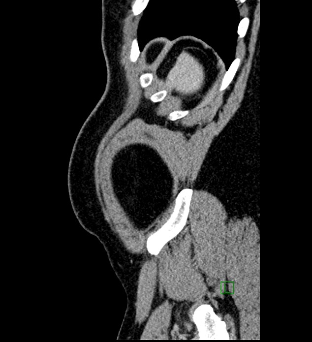 Chromophobe renal cell carcinoma (Radiopaedia 84286-99573 I 9).jpg