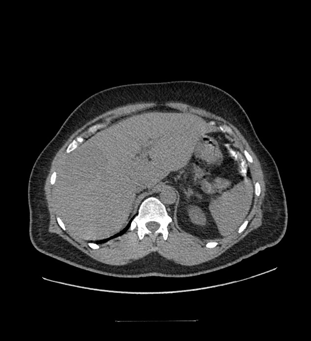 Chromophobe renal cell carcinoma (Radiopaedia 84337-99644 Axial non-contrast 21).jpg
