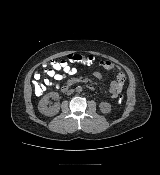 Chromophobe renal cell carcinoma (Radiopaedia 84337-99644 Axial non-contrast 48).jpg