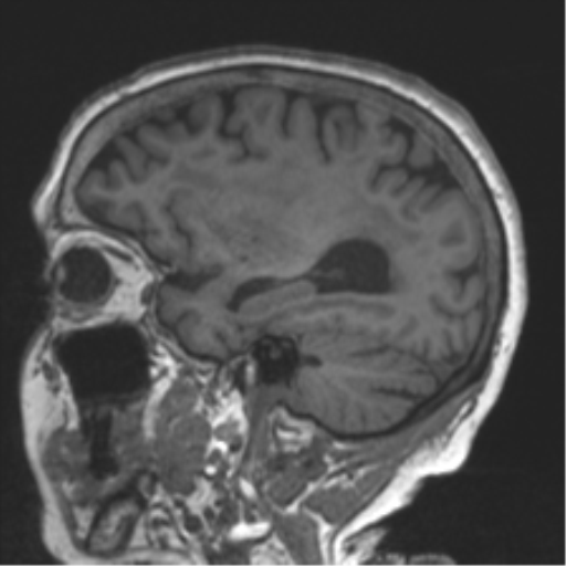 File:Chronic hypertensive encephalopathy (Radiopaedia 39993-42482 Sagittal T1 32).png
