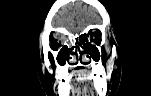 Chronic invasive fungal sinusitis (Radiopaedia 91563-109286 D 30).jpg