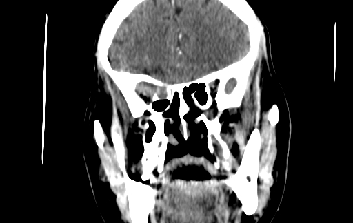 Chronic invasive fungal sinusitis (Radiopaedia 91563-109286 D 62).jpg