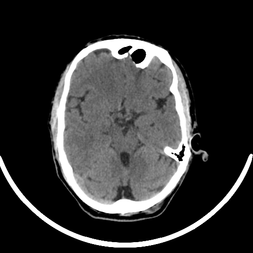 File:Chronic invasive fungal sinusitis with intraorbital and intracranial extension (Radiopaedia 56387-63046 Axial non-contrast 165).jpg