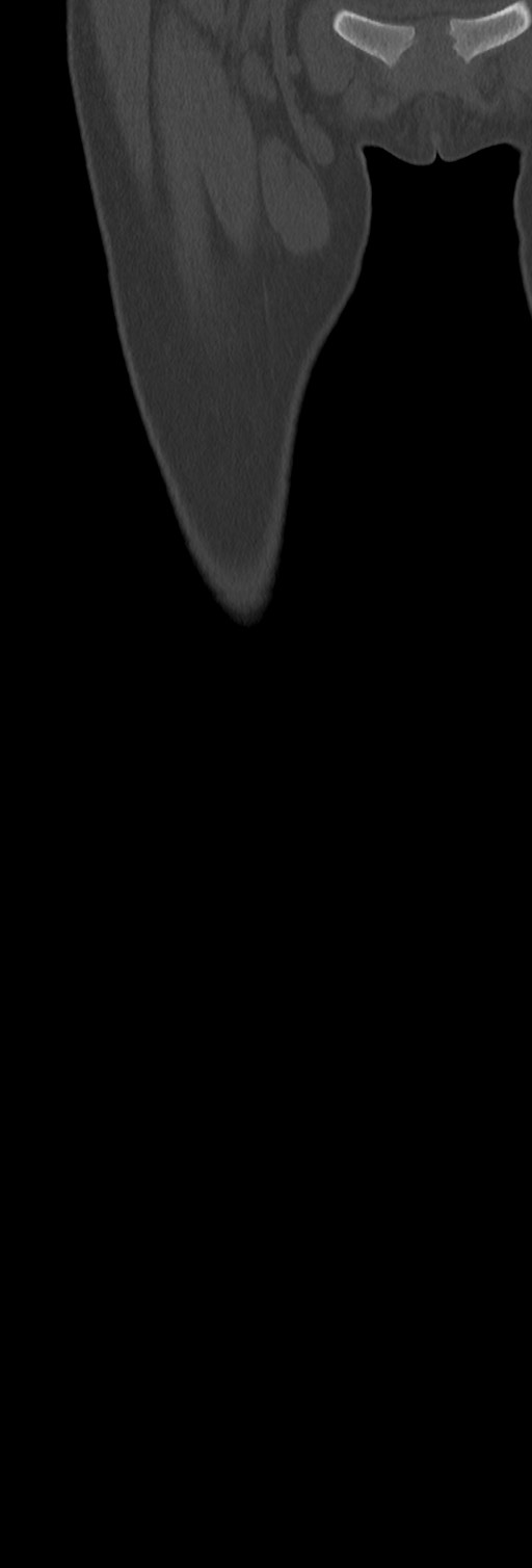 Chronic ostemyelitis of the femur with long sinus tract (Radiopaedia 74947-85982 Coronal bone window 14).jpg