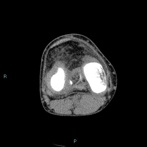 Chronic osteomyelitis (with Brodie abscess) (Radiopaedia 76405-88111 A 114).jpg