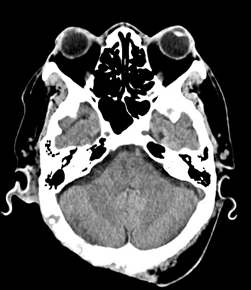 File:Chronic osteomyelitis - calvarial (severe) (Radiopaedia 69668-79616 Axial non-contrast 33).jpg