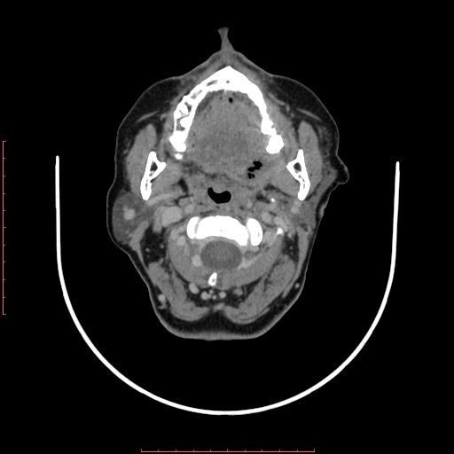 File:Chronic osteomyelitis - maxilla (Radiopaedia 23783-23927 B 56).jpg