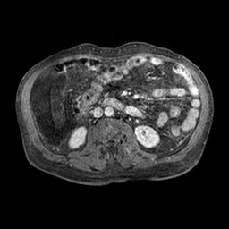 Cirrhosis and hepatocellular carcinoma in the setting of hemochromatosis (Radiopaedia 75394-86594 Axial T1 C+ fat sat 268).jpg