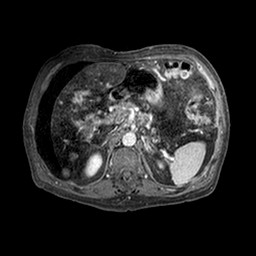 Cirrhosis and hepatocellular carcinoma in the setting of hemochromatosis (Radiopaedia 75394-86594 Axial T1 C+ fat sat 301).jpg