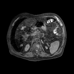 Cirrhosis and hepatocellular carcinoma in the setting of hemochromatosis (Radiopaedia 75394-86594 Axial T1 C+ fat sat 40).jpg