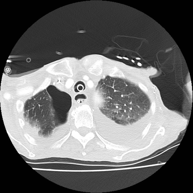 Clagett thoracotomy with bronchopleural fistula (Radiopaedia 29192-29587 Axial lung window 9).jpg