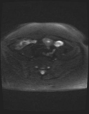 Class II Mullerian duct anomaly- unicornuate uterus with rudimentary horn and non-communicating cavity (Radiopaedia 39441-41755 Axial DWI 37).jpg