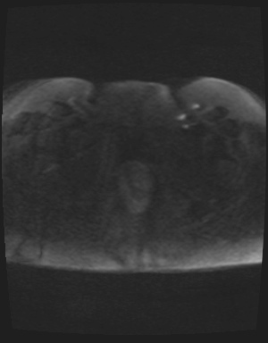 Class II Mullerian duct anomaly- unicornuate uterus with rudimentary horn and non-communicating cavity (Radiopaedia 39441-41755 Axial DWI 92).jpg