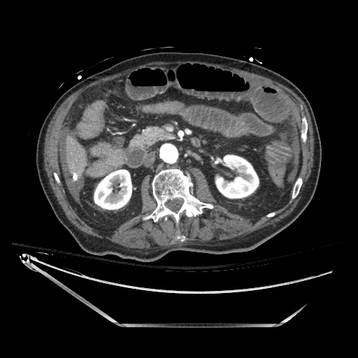 Closed loop obstruction due to adhesive band, resulting in small bowel ischemia and resection (Radiopaedia 83835-99023 B 64).jpg