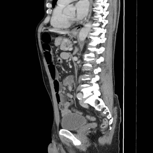 Closed loop small bowel obstruction (Radiopaedia 59227-66554 C 38).jpg