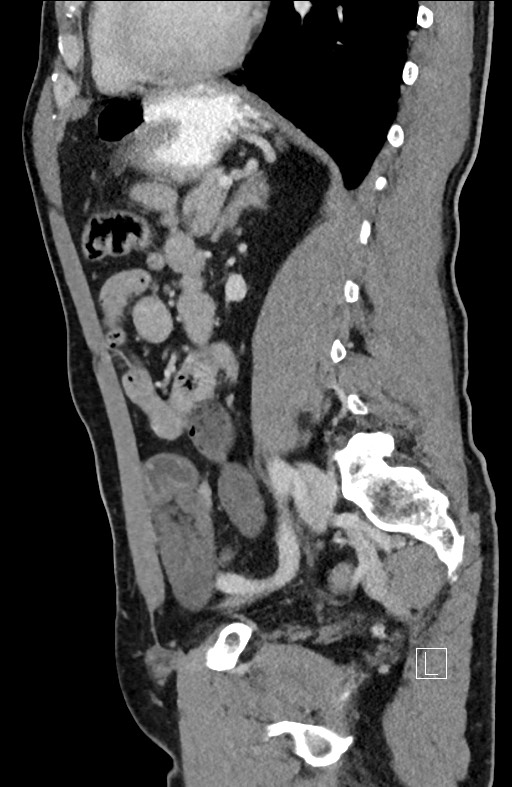 Closed loop small bowel obstruction - internal hernia (Radiopaedia 57806-64778 C 44).jpg