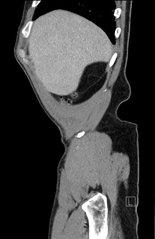 Closed loop small bowel obstruction - internal hernia (Radiopaedia 57806-64778 C 99).jpg