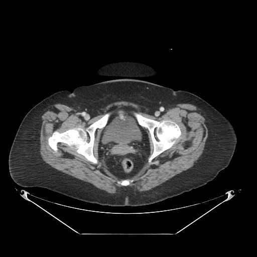 Closed loop small bowel obstruction - internal hernia (Radiopaedia 65402-74450 A 129).jpg