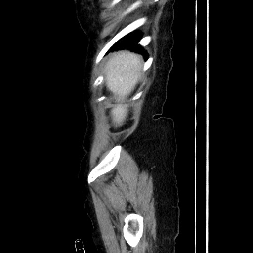 Closed loop small bowel obstruction due to adhesive band, with intramural hemorrhage and ischemia (Radiopaedia 83831-99017 D 42).jpg