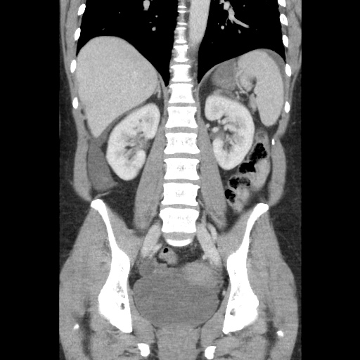 File:Closed loop small bowel obstruction due to trans-omental herniation (Radiopaedia 35593-37109 B 35).jpg