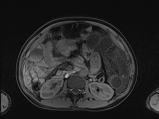 Closed loop small bowel obstruction in pregnancy (MRI) (Radiopaedia 87637-104031 Axial T1 fat sat 54).jpg