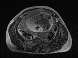 Closed loop small bowel obstruction in pregnancy (MRI) (Radiopaedia 87637-104031 D 19).jpg