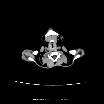 Cloverleaf skull (Radiopaedia 91901-109710 Axial non-contrast 16).jpg