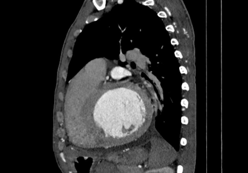Coarctation of aorta with aortic valve stenosis (Radiopaedia 70463-80574 B 121).jpg