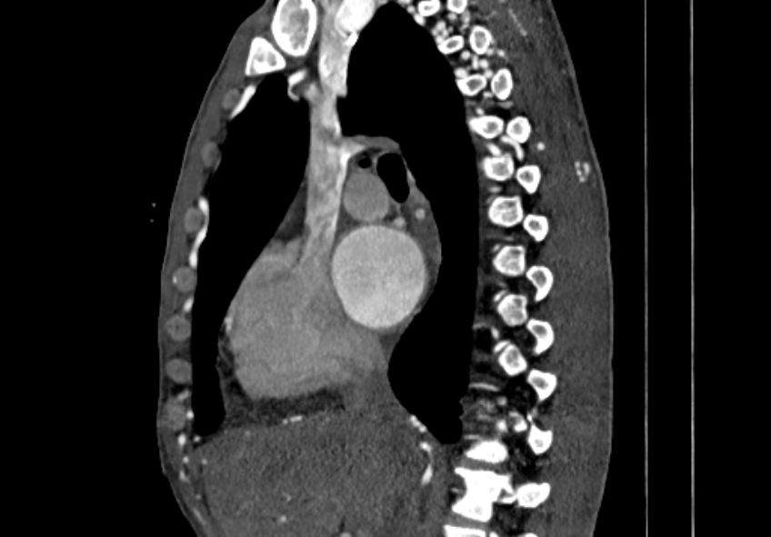 Coarctation of aorta with aortic valve stenosis (Radiopaedia 70463-80574 B 24).jpg