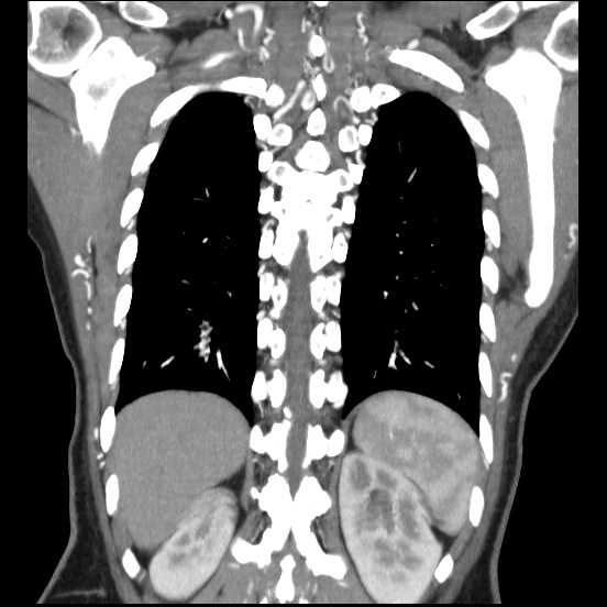 File:Coarctation of the aorta (Radiopaedia 67609-77010 B 16).jpg