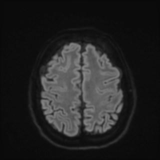 File:Cochlear incomplete partition type III associated with hypothalamic hamartoma (Radiopaedia 88756-105498 Axial DWI 72).jpg