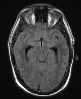 File:Colloid cyst (Radiopaedia 44510-48181 Axial FLAIR 11).png