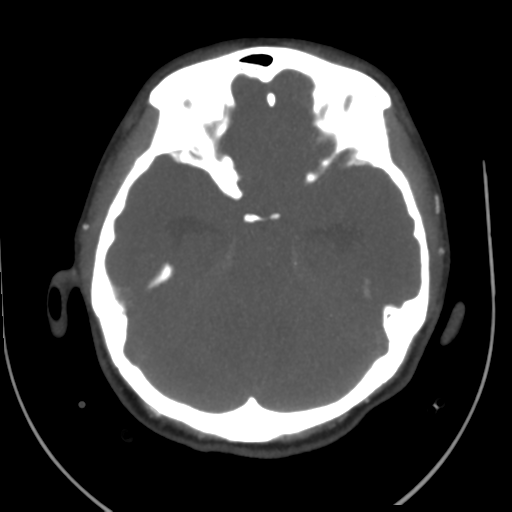 File:Colloid cyst (resulting in death) (Radiopaedia 33423-34499 A 20).png
