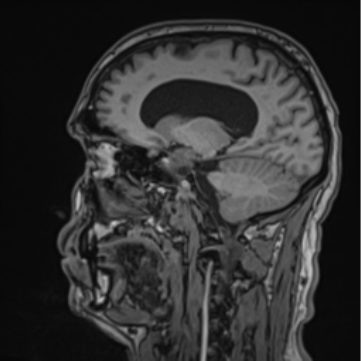 File:Colloid cyst of the third ventricle (Radiopaedia 86571-102662 Sagittal T1 32).png