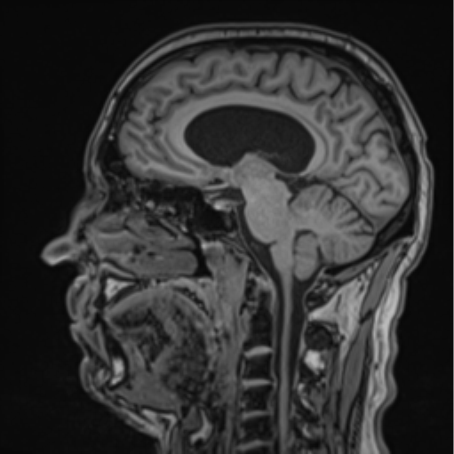 File:Colloid cyst of the third ventricle (Radiopaedia 86571-102662 Sagittal T1 36).png