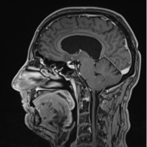 File:Colloid cyst of the third ventricle (Radiopaedia 86571-102662 Sagittal T1 C+ 42).png