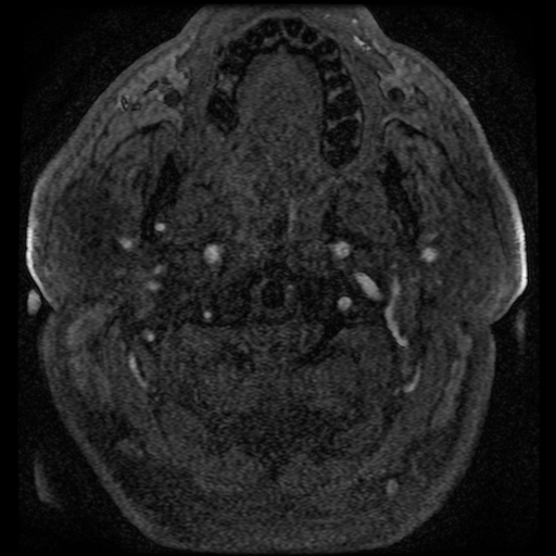 File:Colloid cyst with anterior communicating artery aneurysm (Radiopaedia 33901-35091 Axial MRA 7).jpg