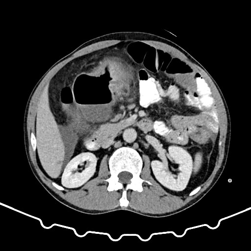 File:Colocolic intussusception due to large lipoma (Radiopaedia 68773-78482 A 70).jpg
