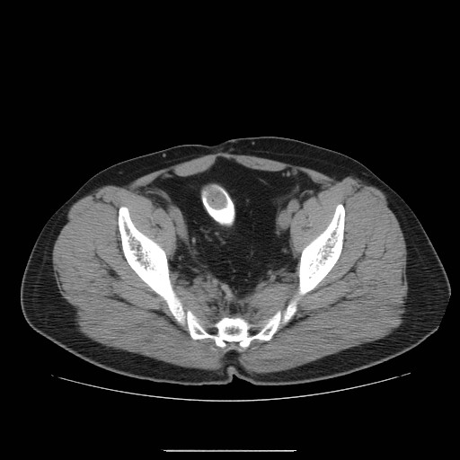 File:Colocutaneous fistula in Crohn's disease (Radiopaedia 29586-30093 D 33).jpg