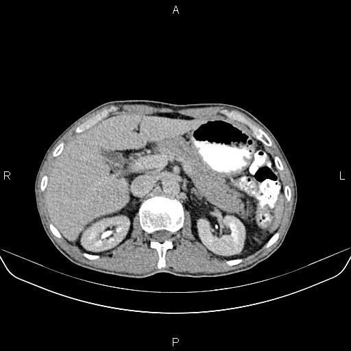 File:Colon adenocarcinoma - hepatic flexure (Radiopaedia 85635-101395 Axial C+ delayed 27).jpg