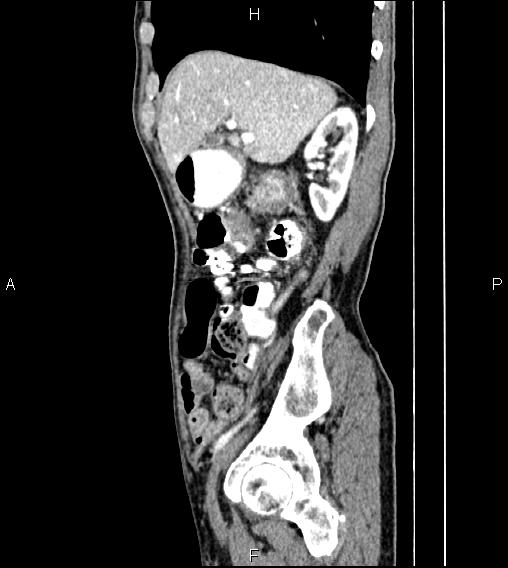 Colon adenocarcinoma - hepatic flexure (Radiopaedia 85635-101395 D 24).jpg